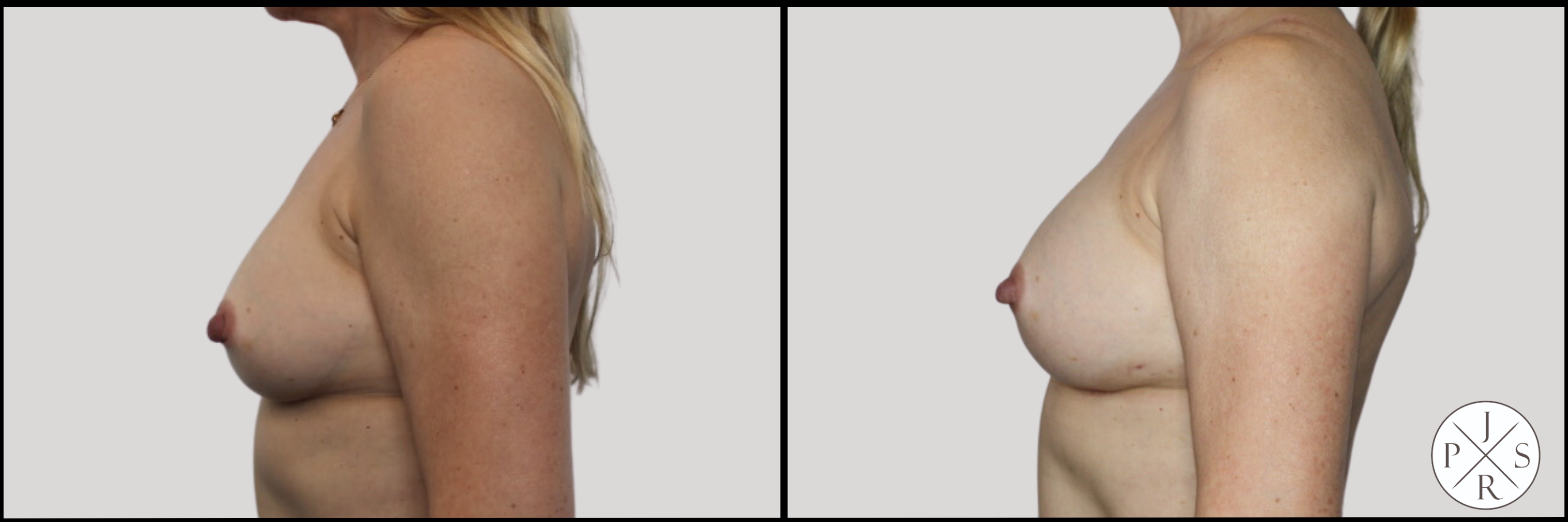 Breast Revision Before & After Image